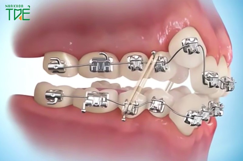 Đeo chun liên hàm khi niềng giúp kéo và căn chỉnh lại răng hai hàm trên - dưới