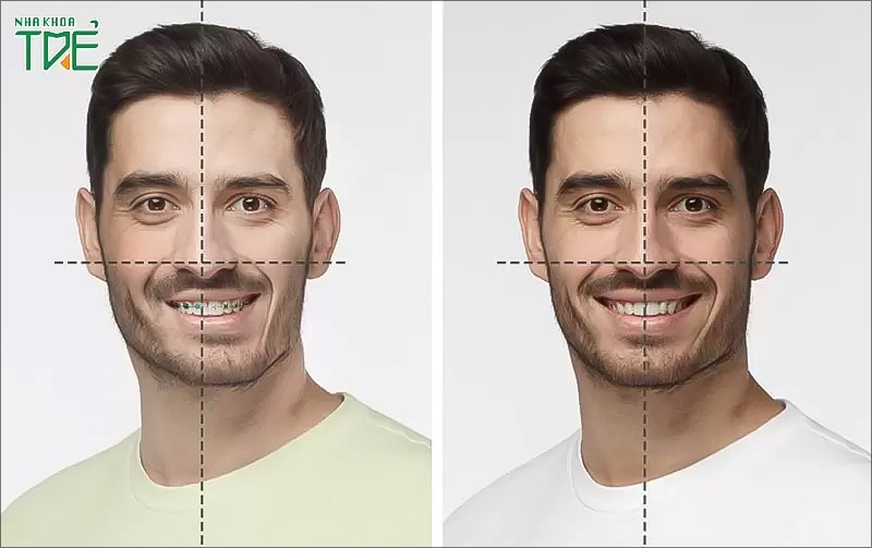 Niềng răng có thể khắc phục tình trạng khuôn mặt mất cân đối
