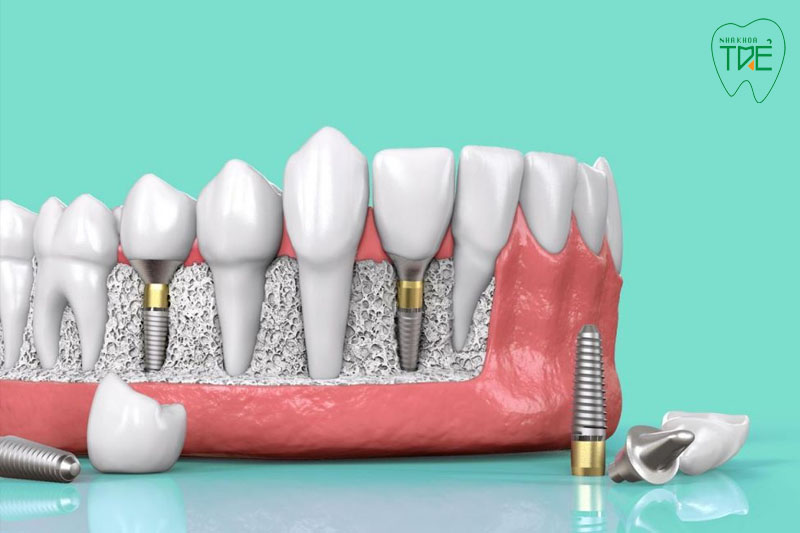  Trồng răng Implant phục hình từ chân răng