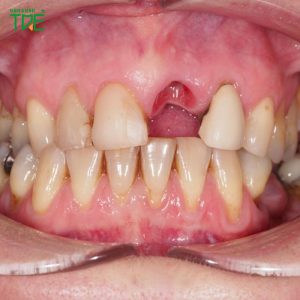 Mất răng cửa gây hại gì? Giải pháp trồng răng giả nào tốt?