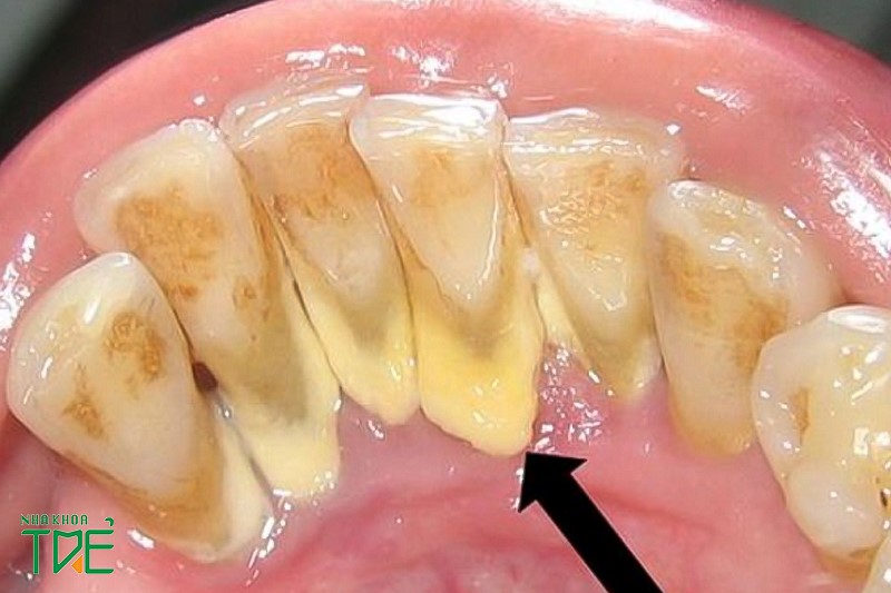 Sự hình thành mảng bám răng là nguyên nhân dẫn đến viêm quanh răng