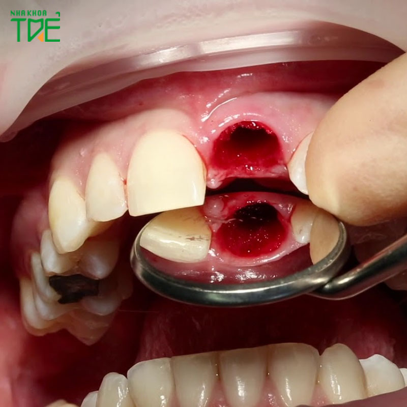 Cảnh báo biến chứng trồng răng Implant bị nhiễm trùng và cách xử lý