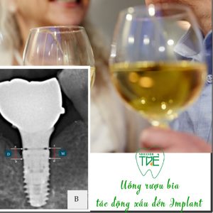 Rượu bia gây ảnh hưởng đến trồng răng Implant: 5 tác hại khó lường
