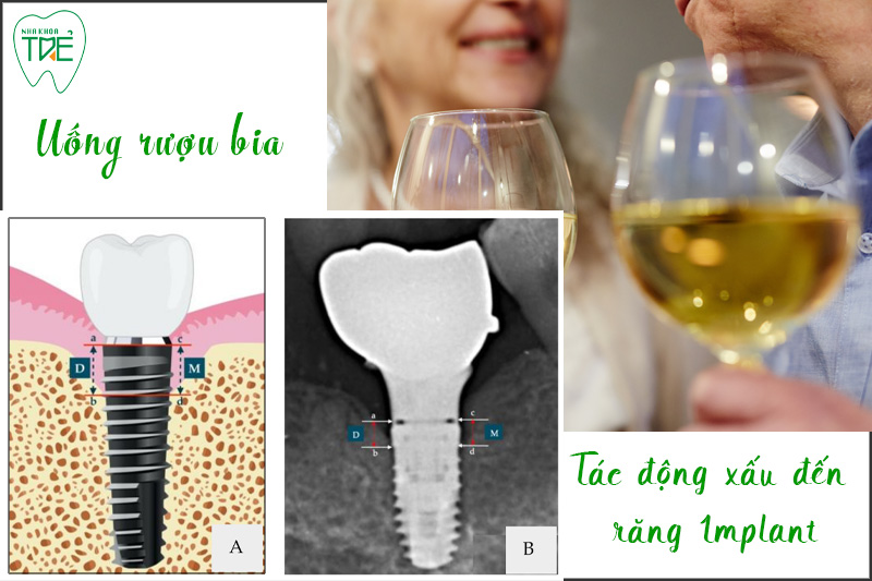 Uống rượu bia gây ảnh hưởng đến trồng răng Implant