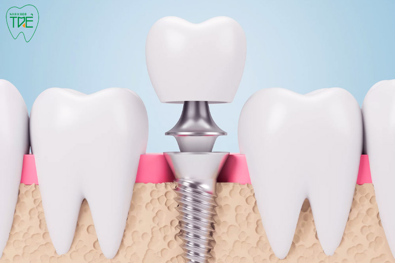 Trồng răng Implant cần ghép chân răng giả vào xương hàm