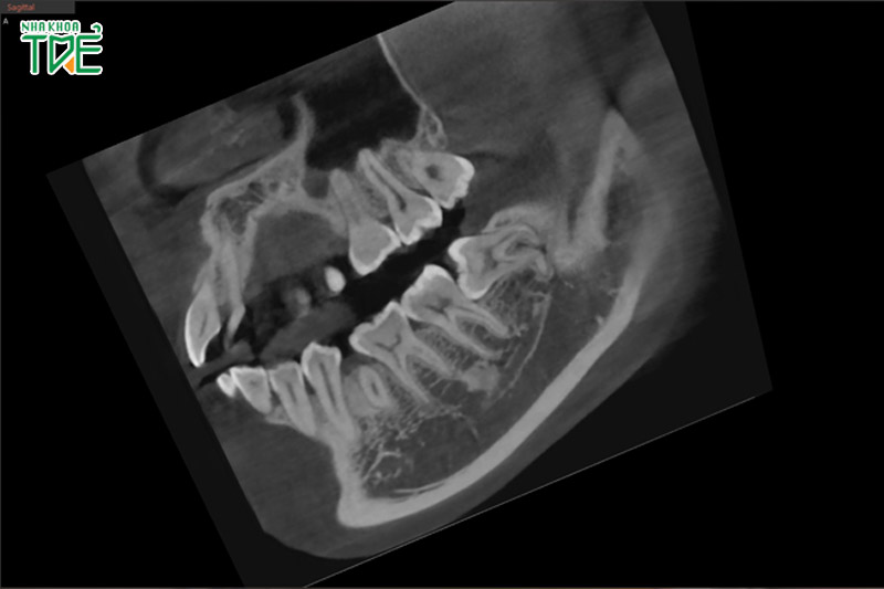 Chẩn đoán viêm ổ răng khô qua ảnh chụp X-quang