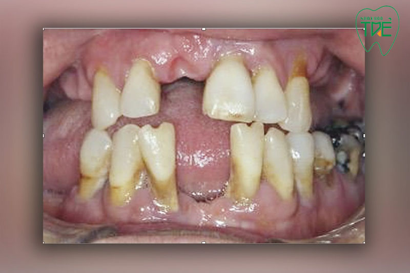 Mất răng gây ra nhiều biến chứng