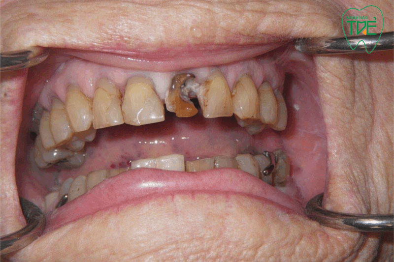 Răng hư hỏng quá nặng không thể bọc răng sứ