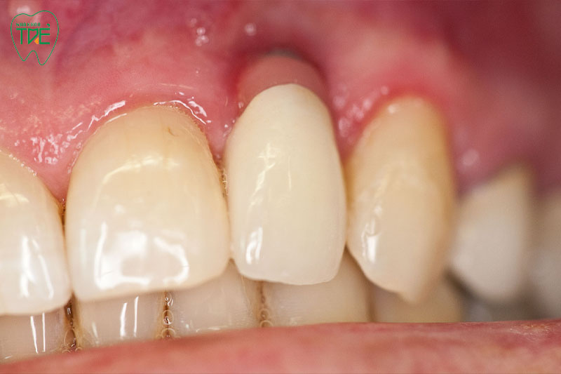 Răng sứ bị hở chân răng