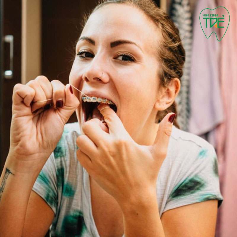 Dùng chỉ nha khoa khi niềng răng: Lợi ích và cách dùng đúng chuẩn