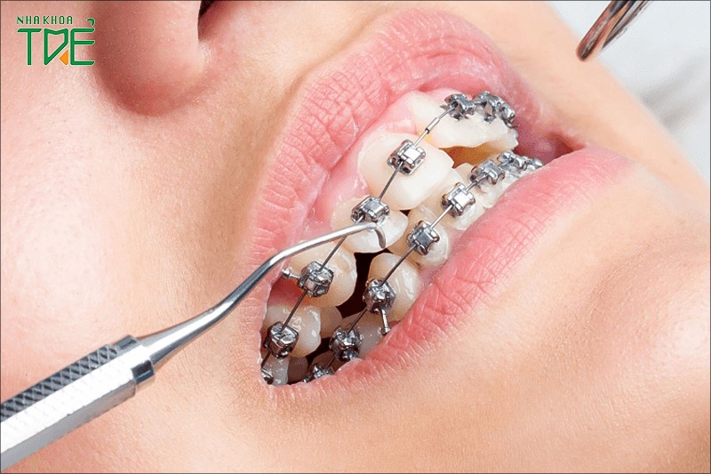 Niềng răng sẽ dẫn đến nhiều hậu quả nếu bạn chọn phải nha khoa kém uy tín