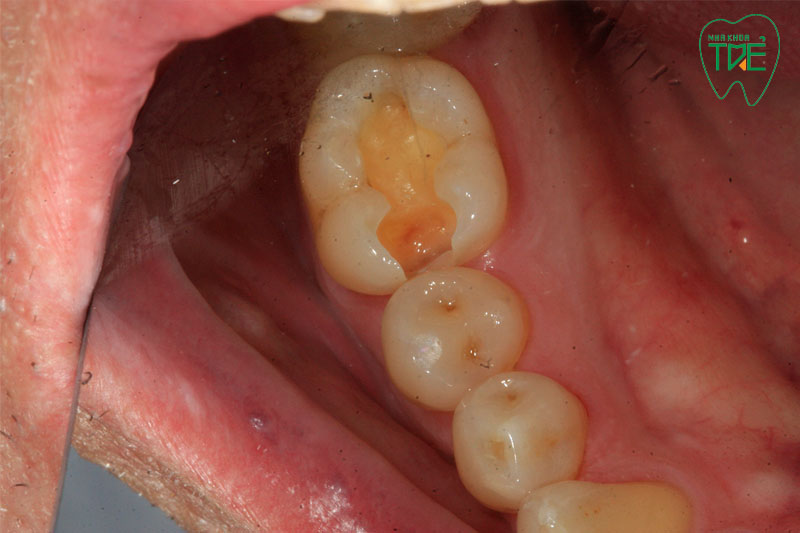 Cần bọc răng sứ cho răng sâu