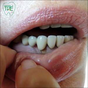 Thận trọng trước 7 tác hại của việc bọc răng sứ sai cách