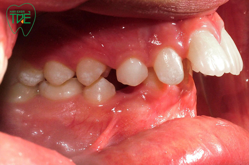 Răng hô vẩu cần tạo khoảng trống để kéo lùi nhóm răng cửa