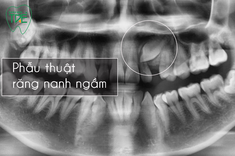 Nhổ răng mọc ngầm khi niềng răng