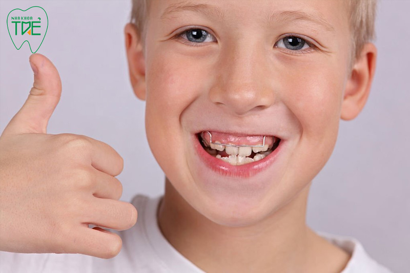 Niềng răng hiệu quả khi răng và xương hàm đang phát triển