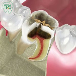 Tủy răng bị thối: Nguyên nhân, dấu hiệu, tác hại và cách xử lý