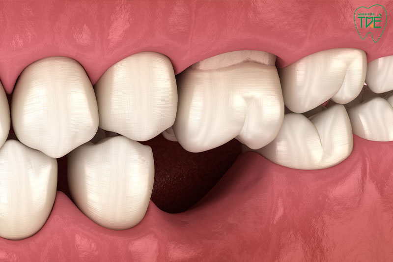 Viêm tủy răng gây mất răng vĩnh viễn