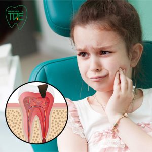 Viêm tủy răng ở trẻ em: Nguyên nhân, tác hại và cách xử lý