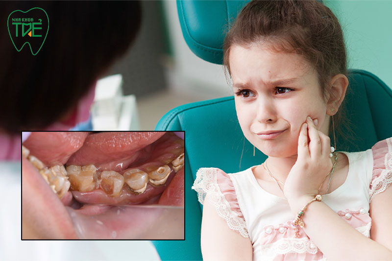 Viêm tủy răng ở trẻ em gây đau nhức cùng nhiều biến chứng khác