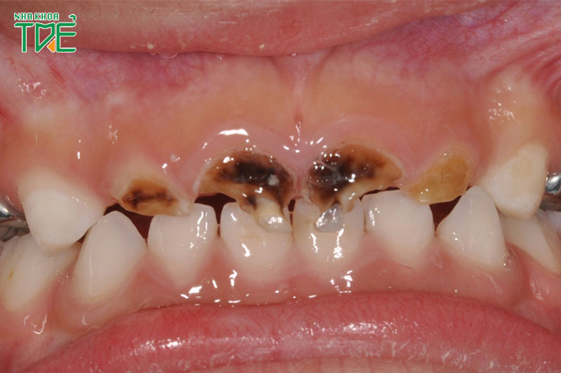 Bệnh ăn mòn chân răng ở trẻ em: Cách phòng ngừa và xử lý kịp thời