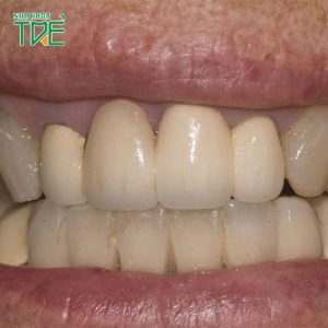Bọc răng sứ kém chất lượng: Cảnh giác trước biến chứng khó lường