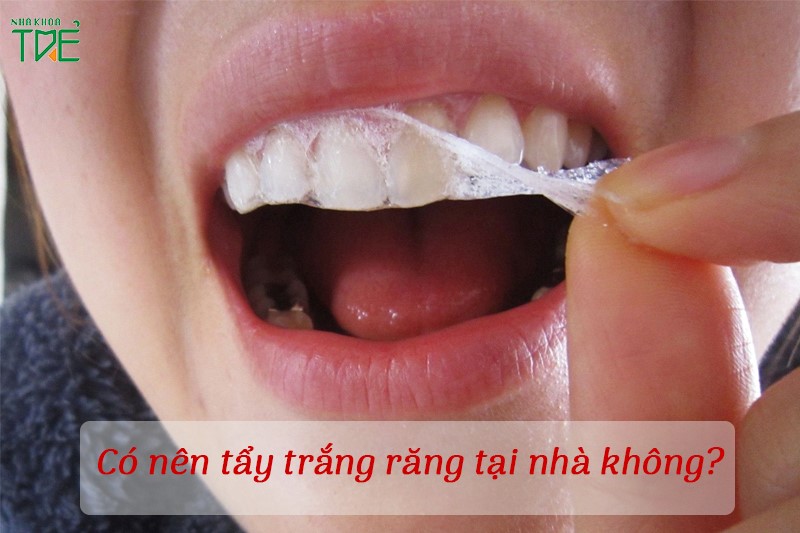 Có nên tẩy trắng răng tại nhà không? Liệu tẩy tại nhà có an toàn?