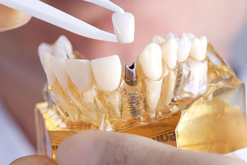 Từ A-Z những lưu ý khi trồng răng Implant bạn nên biết