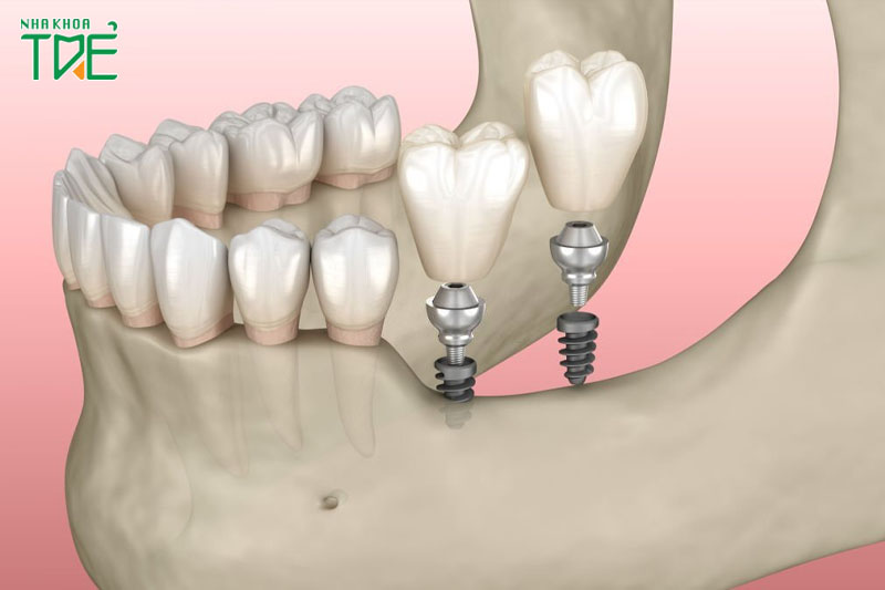 Xương hàm bị tiêu biến không còn đủ chỗ để đặt trụ Implant
