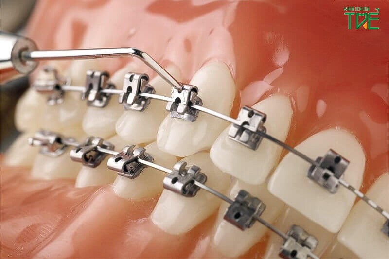 Niềng răng bao lâu thì thay dây cung phụ thuộc theo từng giai đoạn