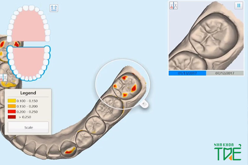 Phục hình răng sứ bằng máy iTero