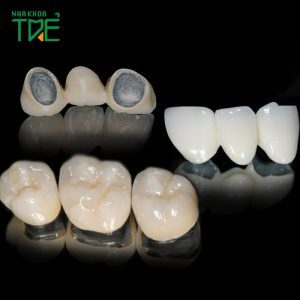 Răng sứ kim loại và răng sứ Titan: Giống và khác nhau thế nào?