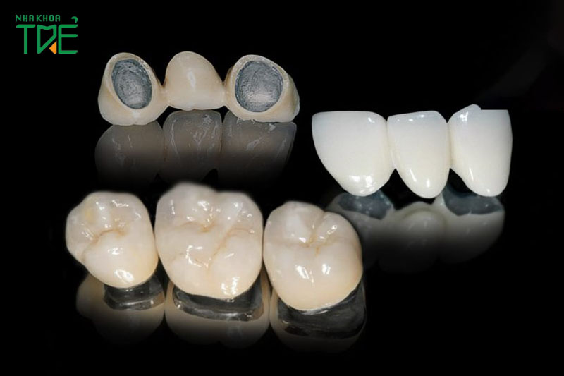 Răng sứ kim loại và răng sứ Titan: So sánh sự khác nhau
