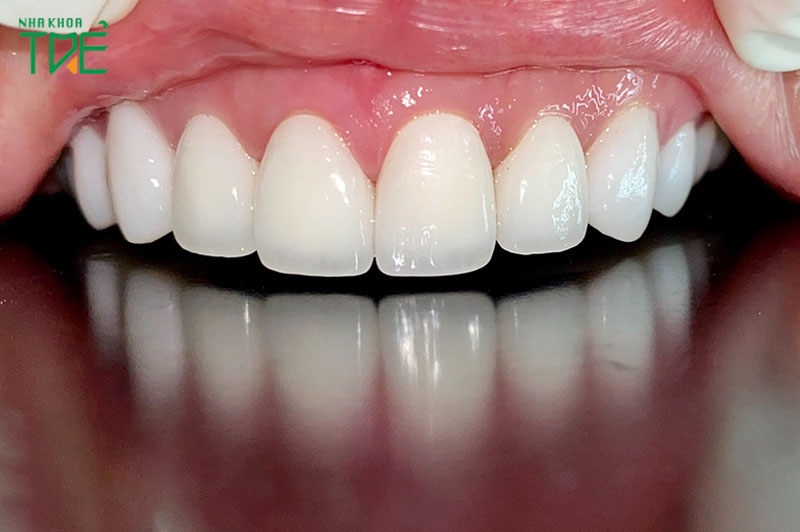 Răng cửa yêu cầu loại răng sứ có thẩm mỹ cao
