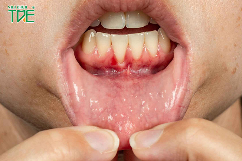 Viêm quanh cuống răng: Nguyên nhân, dấu hiệu và cách điều trị triệt để