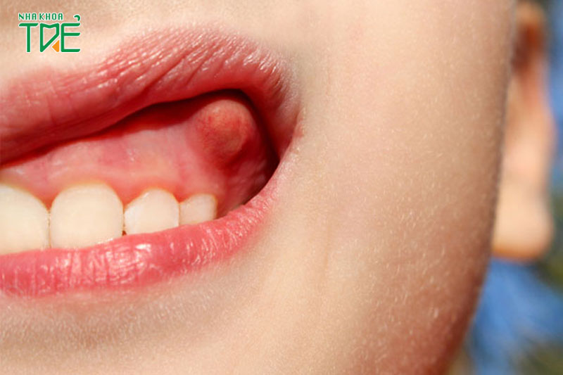 Hậu quả nguy hại khi bị viêm cuống răng