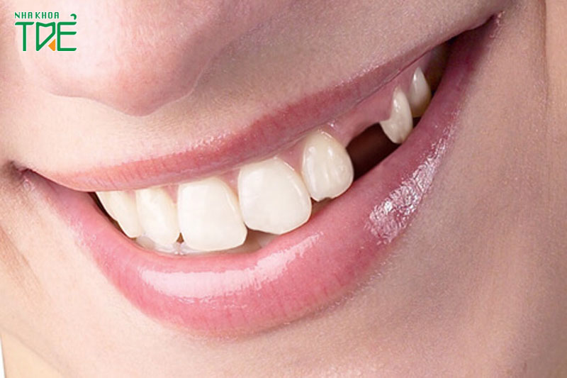 17 tuổi nhổ răng không thể mọc lại răng