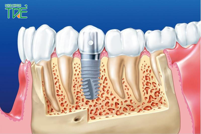 Trồng răng implant - giải pháp phục hình tối ưu