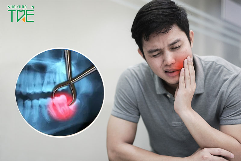 6 Cách giảm đau sau nhổ răng khôn được chuyên gia chia sẻ