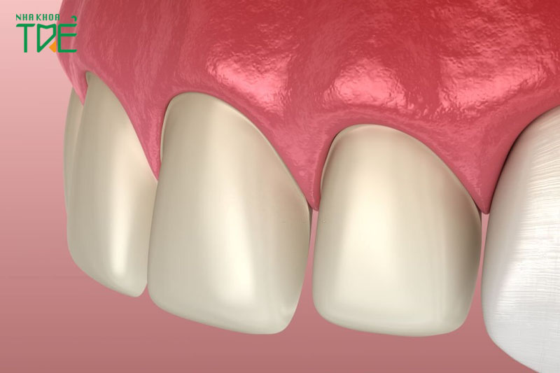 Hạn chế mài răng với kỹ thuật dán răng sứ