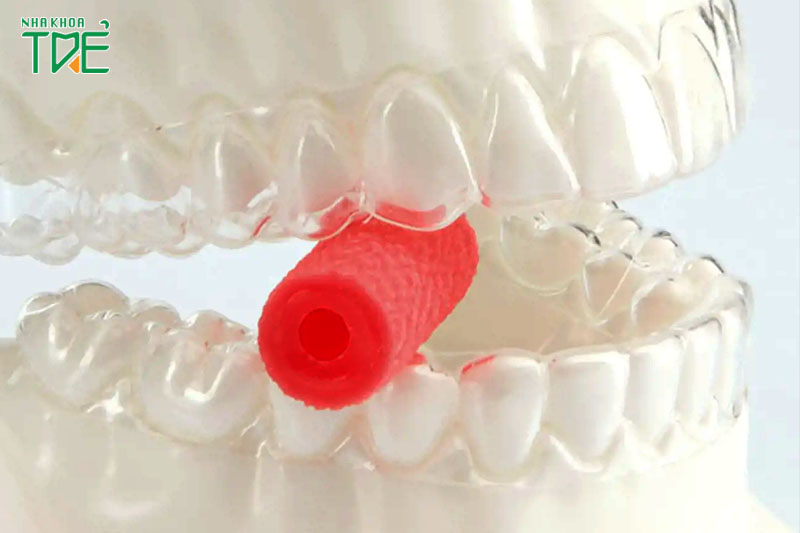 Sử dụng đệm cắn giúp răng sát hoàn toàn với khay niềng
