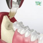 Nhổ răng khôn có gây hại gì không? Cần lưu ý gì?