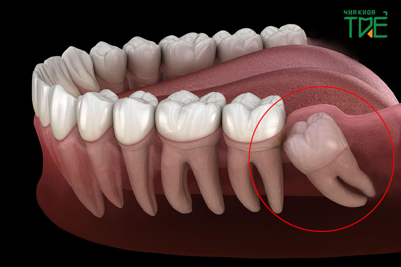 Răng khôn số 8 nằm trong cùng trên cung hàm