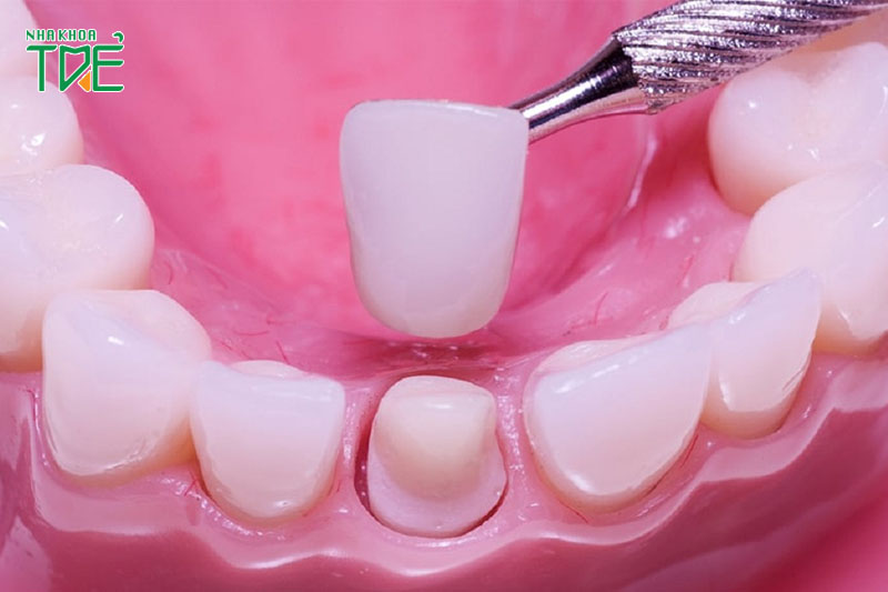 Răng giả tạm thời là gì? Có mấy loại? Khi nào cần sử dụng?