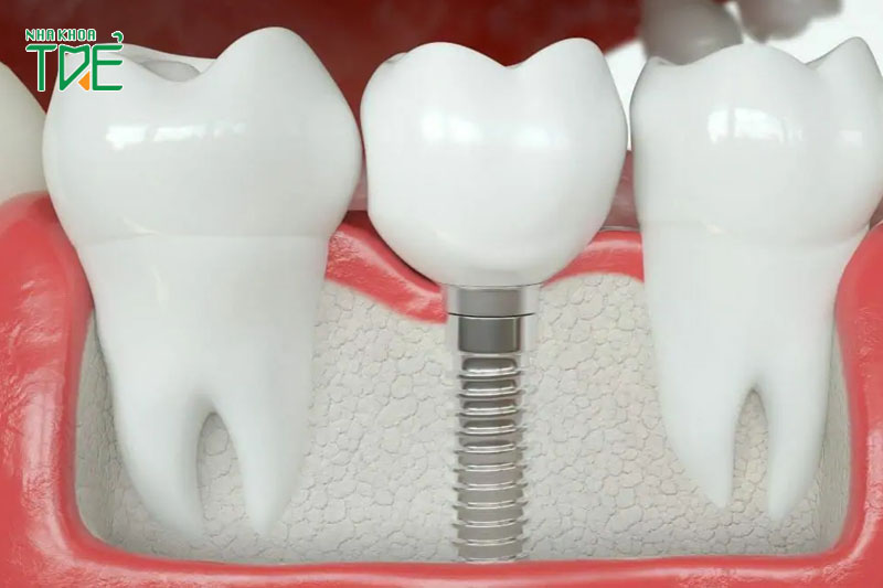 Răng tạm trong trồng răng Implant