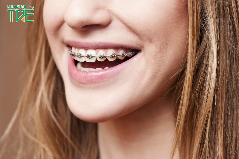 Niềng răng cải thiện thẩm mỹ, sức khỏe răng miệng
