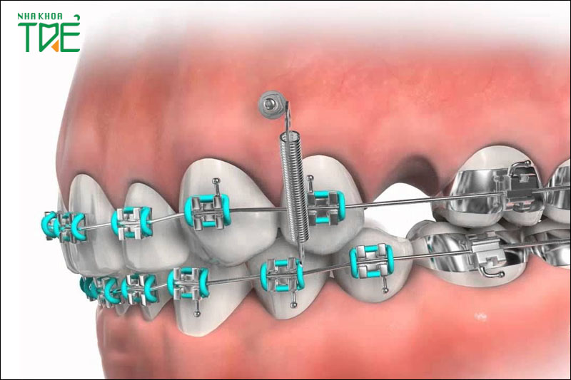 Niềng răng ở người trưởng thành có thể phải nhổ răng, gắn minivis