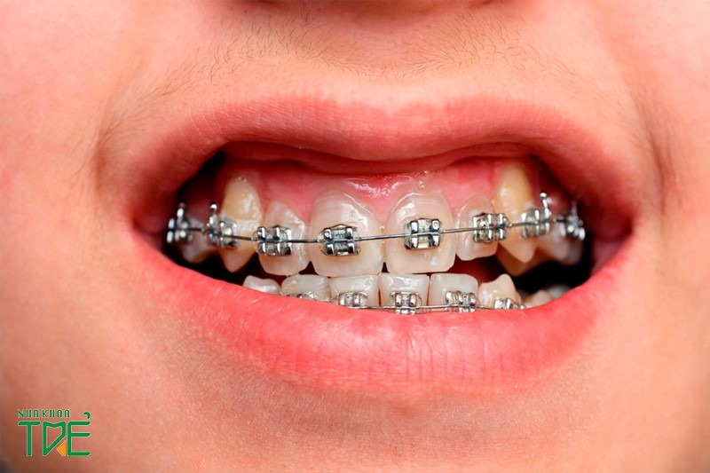 Niềng răng áp dụng với trường hợp cười hở lợi bị bị sai khớp cắn