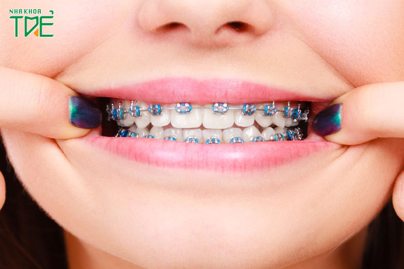 Hiểu lầm về niềng răng và những điều cần lưu ý tuyệt đối