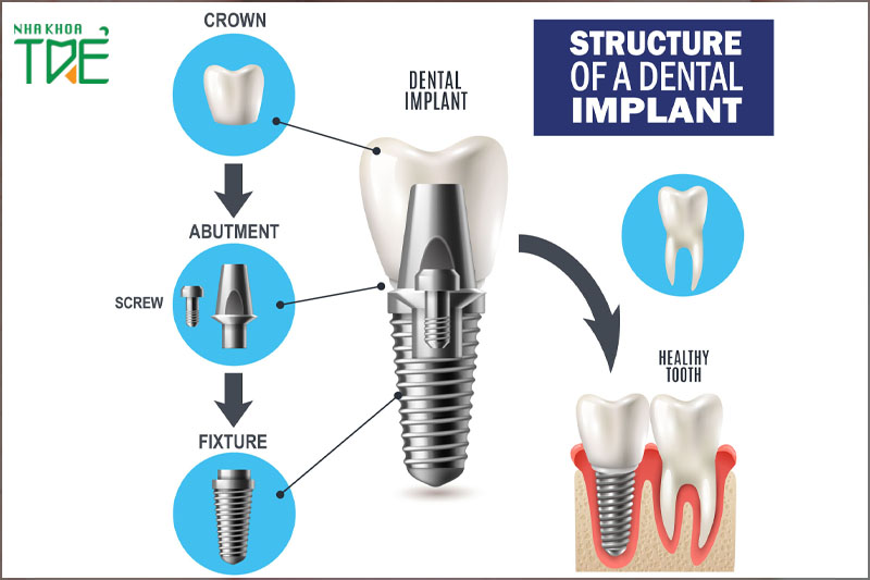 Cấu trúc răng Implant gồm trụ răng, Abutment và răng sứ
